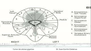 Tumor de células gigantes [upl. by Faustus]