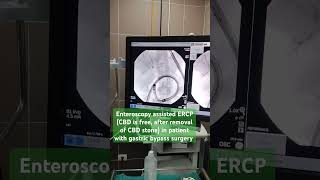 Enteroscopy assisted ERCPCBD is freeafter removal of CBD stonepatient with gastric bypass surgery [upl. by Aimar]