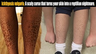 Ichthyosis vulgaris A scaly curse that turns skin into reptilian nightmare [upl. by Trisha85]