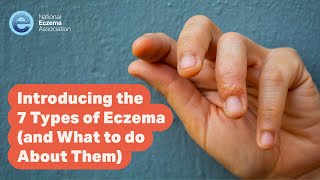 Introducing the 7 Types of Eczema and What to do About Them [upl. by Kyle]