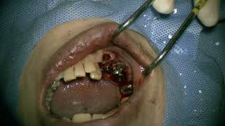 Straumann NC RN WN place in posterior mandible 4 [upl. by Oir]