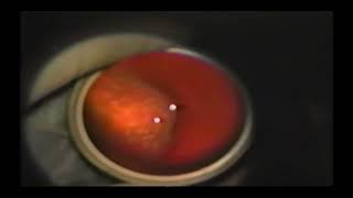 Retinal detachment Encircling laser retinopexy technique  Supplementary video 1 ID 406337 [upl. by Ilrahc]