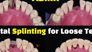 Dental Splinting for loose teeth using a ribbond after tooth extraction [upl. by Nediarb]