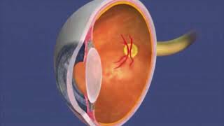 Audio Description Animation Retinopathy of Prematurity [upl. by Aimac]