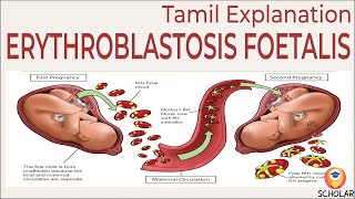 Understanding Erythroblastosis Fetalis Causes Symptoms and Treatments  Tamil Explanation [upl. by Bouchard259]