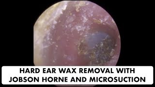 HARD EAR WAX REMOVAL WITH JOBSON HORNE AND MICROSUCTION  Ep 20 [upl. by Souvaine945]