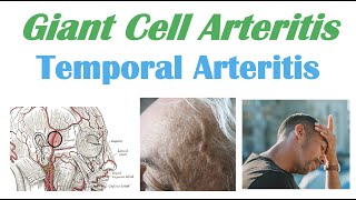 Giant Cell Arteritis Temporal Arteritis  Causes Pathophysiology Symptoms Diagnosis Treatment [upl. by Ennaeed]