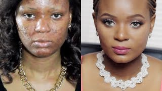 My Skin Care Miracle How I Got Rid of Acne Acneorg quotThe Regimenquot [upl. by Kennan]