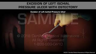 Excision of Left Ischial Pressure Ulcer with Ostectomy [upl. by Joachim906]