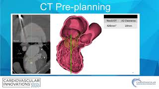 A novel mitral case  Anene Ukaigwe MD [upl. by Vinaya]