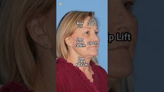 Deep Plane Facelift Results  Dr Kevin Sadati [upl. by Araid482]