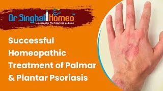 Critical Case of Palmar amp Plantar Psoriasis Effectively Treated at Dr Singhal Homeo Chandigarh [upl. by Ades]