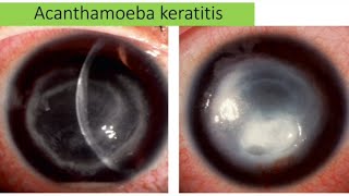 Acanthamoeba keratitis  causes sign clinical pictures management [upl. by Dibrin]