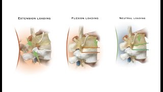 Bulging disc and back pain model  teaching biomechanics [upl. by Sheldon]