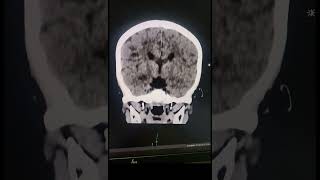 Corpus Callosum Agenesis  Radiology [upl. by Gilberta729]