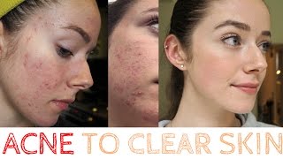 Acne to Clear Skin my ROACCUTANE Journey raw footage [upl. by Gloriane492]