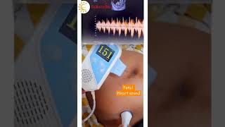 Fetal Heart sound  Nonstress Test Pregnancy nst fetal heart sound shortsvideo [upl. by Annotahs905]