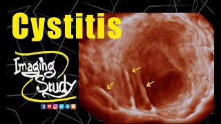 Cystitis  Ultrasound  3D  Case 228 [upl. by Myrtice]