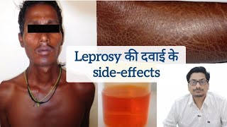 Leprosy की दवाई के sideeffects  Clofazimine  Hansepran  Rifampicin leprosy clofazimine कुष्ट [upl. by Iclek]