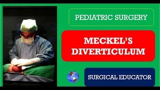 MECKELS DIVERTICULUM How To DIAGNOSE amp TREAT Pediatric Surgery [upl. by Yanad]