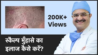 AcnePimples On Scalp How to treat Acne On Scalp स्कैल्प मुँहासे का इलाज कैसे करें  In HINDI [upl. by Sorcha]