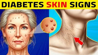 8 Diabetes Skin Signs You Shouldnt Ignore [upl. by Bruni]