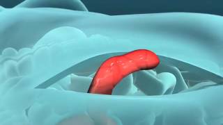 How an Appendix Is Removed [upl. by Baudoin164]