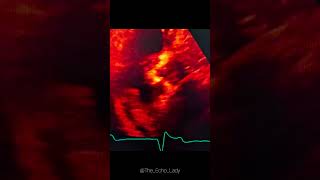 Endocarditis vs Thrombus🩸🦠 endocarditis echocardiography cardiologie cardiology [upl. by Yentnuoc]