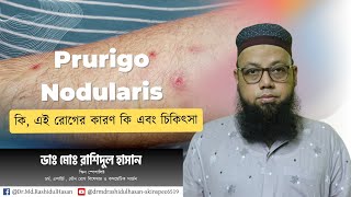 অত্যন্ত মারাত্মক চুলকানির রোগ প্রুরায়গো নডিউলারিসPrurigo Nodularis [upl. by Aribold]