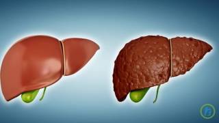 What is Liver cirrhosis [upl. by Eerazed]