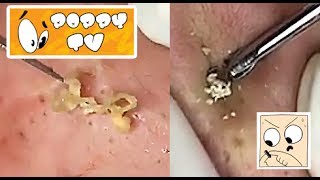 Large Closed Comedones  Whiteheads Extraction [upl. by Fesuoy]