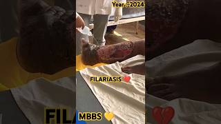 🧑🏻‍🔬FILARIASIS 💔mbbsdoctorfilariasisjoharimbbsneetmbbmbbsdairiesdiseasecancerlifestylepw🪷 [upl. by Trout85]