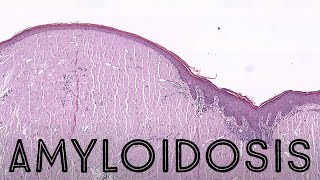 Amyloidosis nodular vs systemic AL light chain type amyloid pathology dermpath [upl. by Eladnor]