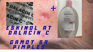 cheap and effective  acne solution [upl. by Lia]