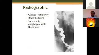 Why Cant I Swallow The Science Behind Dysphagia [upl. by Baudin]