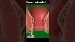 remove hemorrhoids laser 3danimationsurgery crazypharmaguruji1331 goodtoknow [upl. by Paulie]