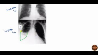 Community Acquired Pneumonia for USMLE Step 2 [upl. by Togram]