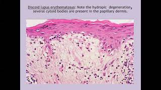 Lecture59 Discoid and Subacute Cutaneous Lupus Erythematosus Rooks chapter 51 [upl. by Brainard]