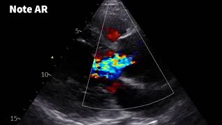 Aortic root aneurysm with AR [upl. by Coralie]