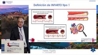 CONCEPTOS 2019  Las troponinas UltraSensibles ¿Nos ayudan o nos complican el diagnóstico del SCA [upl. by Einattirb143]