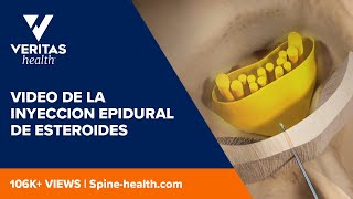 Video de la inyeccion epidural de esteroides [upl. by Stanislas]