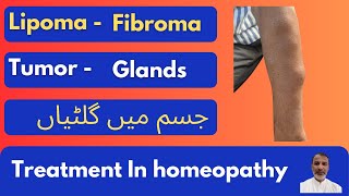 lipoma Fibroma Tumor Glands جسم میں گلٹیاں treatment in homeopathy Dr usman ghani [upl. by Deanne160]