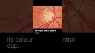 Examining the fundus – part 2 ophthalmology [upl. by Faunia]