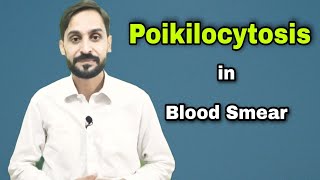 Poikilocytosis  Types of Poikilocytosis  4th Video  Blood Smear Series [upl. by Adnarb99]