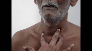 Tracheal palpation  Insinuation method video only [upl. by Childs]