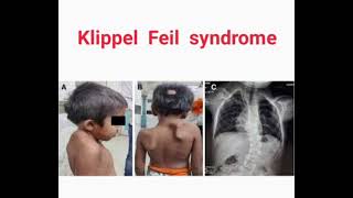 Klippel feil syndrome mrcpch Clinical [upl. by Caitrin352]