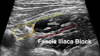 POCUS Case Fascia Iliaca Nerve Block [upl. by Townsend309]