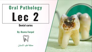 Oral Pathology Dental caries  اورل باثو المحاضرة الثانية [upl. by Nevsa]