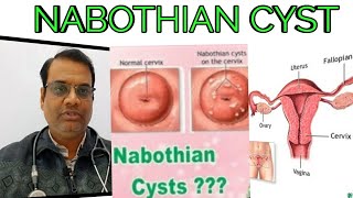 NABOTHIAN CYSTCAUSE  SYMPTOMS  HOMEOPATHIC MEDICINE [upl. by Jackson]