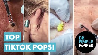 Dr Pimple Popper’s Top 10 Tiktok Pops [upl. by Euqinamod]